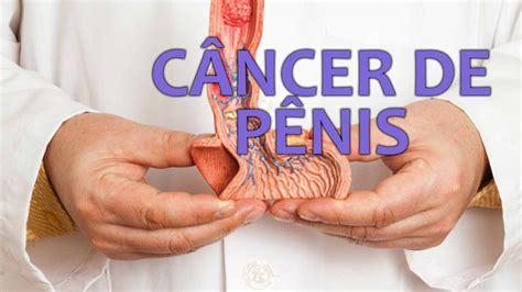 sintomas de câncer de pênis-1
